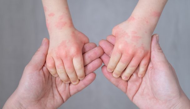 Close,Up,Mother,Holding,Kids,Hands,With,Allergic,Rash,Or
