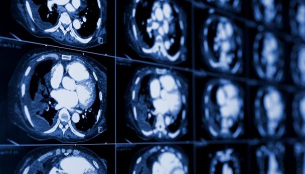 Computed,Tomography,Of,The,Chest.,Medical,Background.,Monochrome,Photos