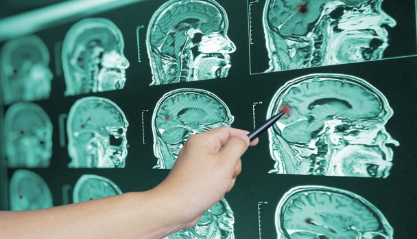 Close,Up,Hand,Doctor,Point,Brian,Scan,Image,Of,A