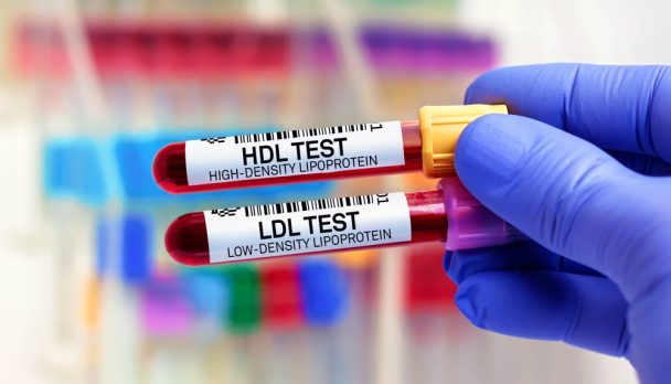 Blood,Samples,Of,Patient,For,High,Density,Lipoprotein,Hdl,And
