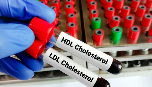 Blood,Samples,For,Hdl,Cholesterol,(good,Cholesterol),And,Ldl,Cholesterol